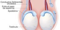 Vasectomía en pachuca