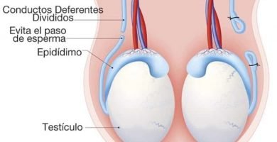 Vasectomía en pachuca